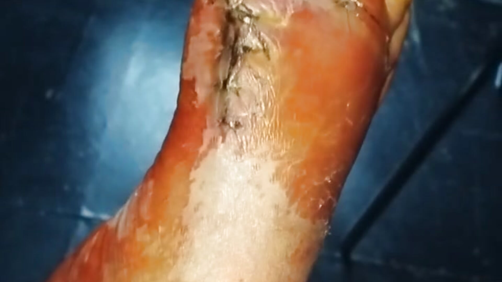 foot after surgery