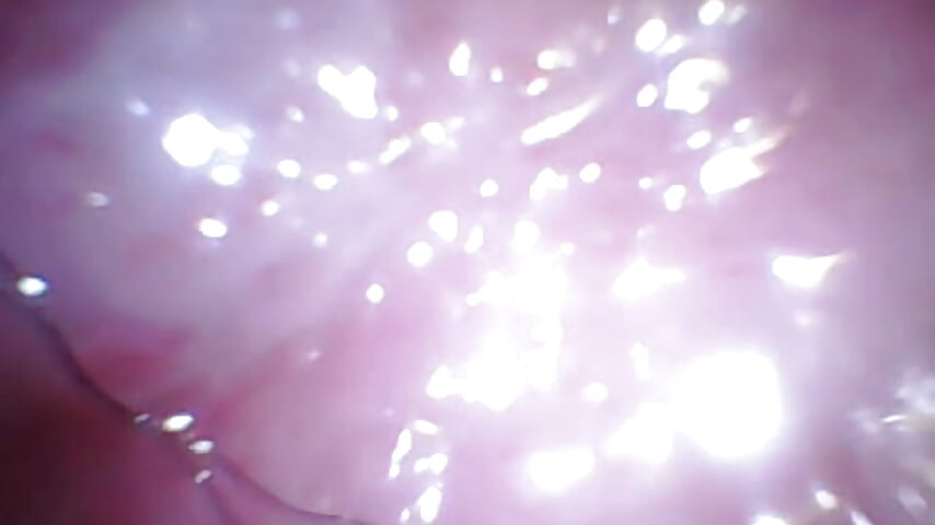 内窥镜阴道里的我Me in the vagina with endoscope