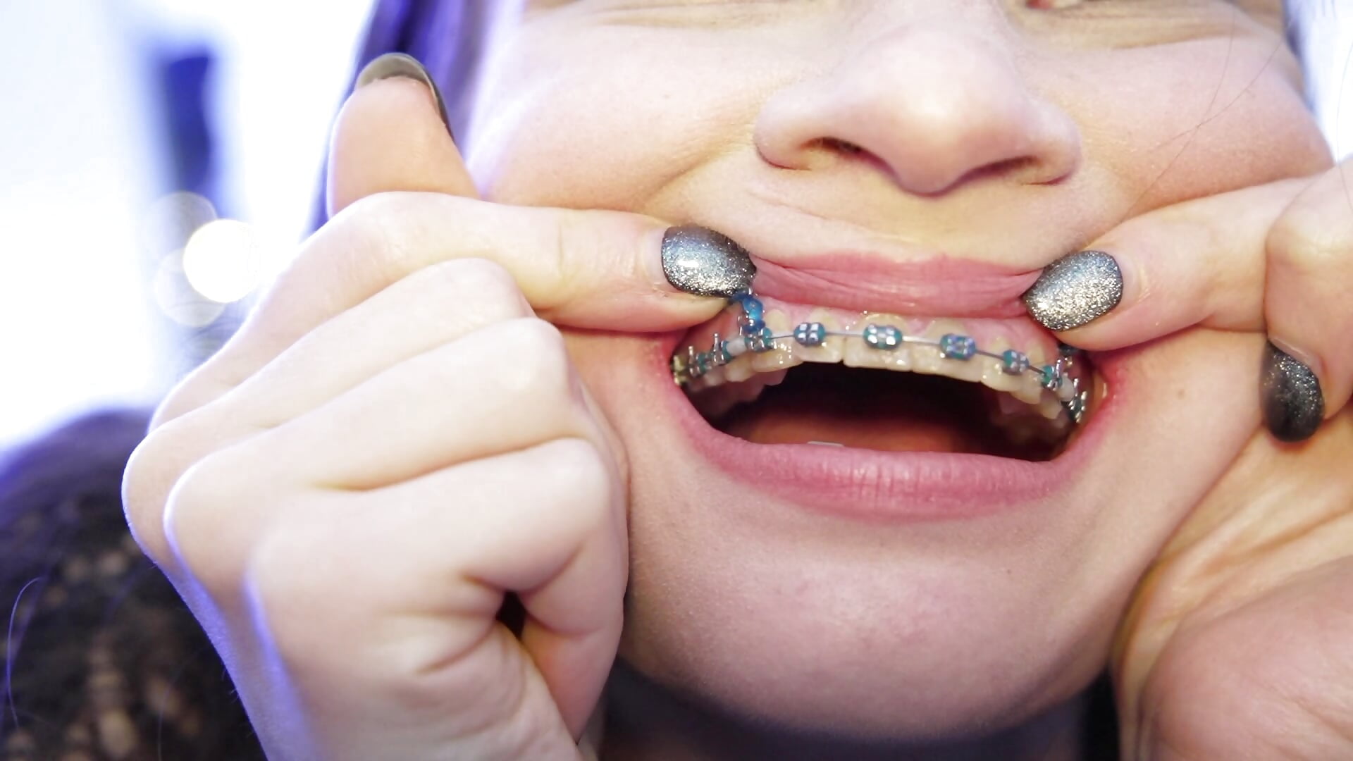 Braces Closeup Diary