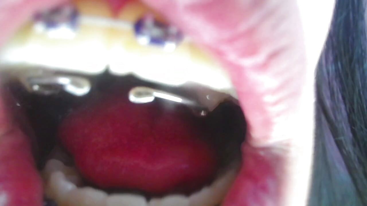 Braces and expander