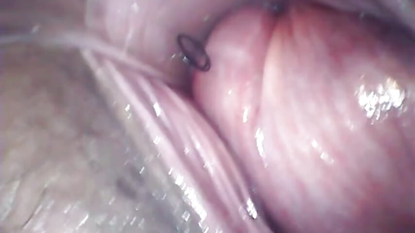 内窥子宫  uterus  endoscopy