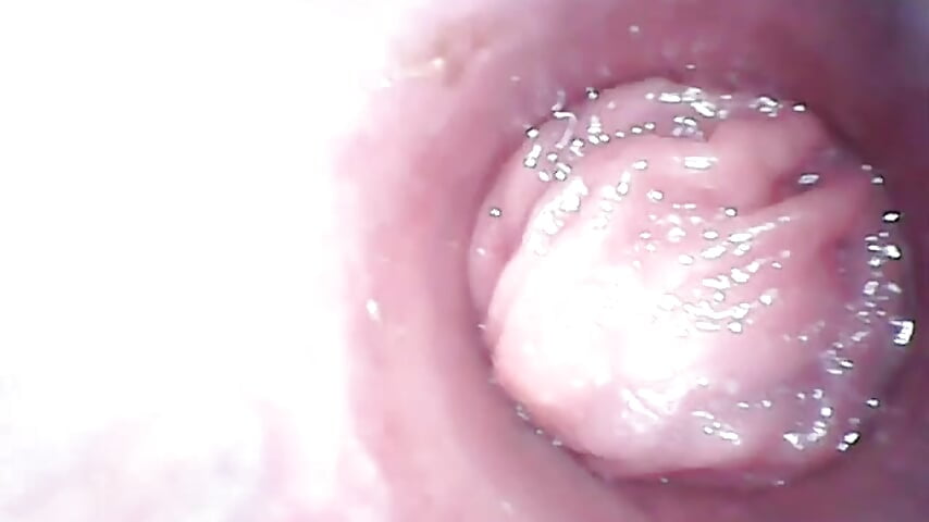 anal  endoscopy  内窥菊花