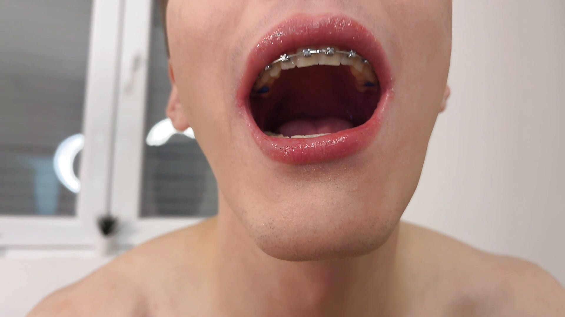 Explore my braces