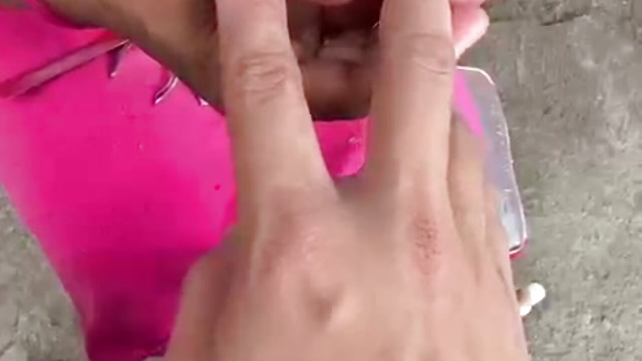 Ingrown Removal