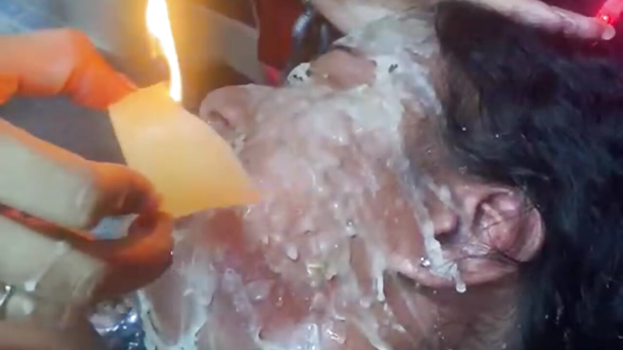 Hot candle wax on the face
