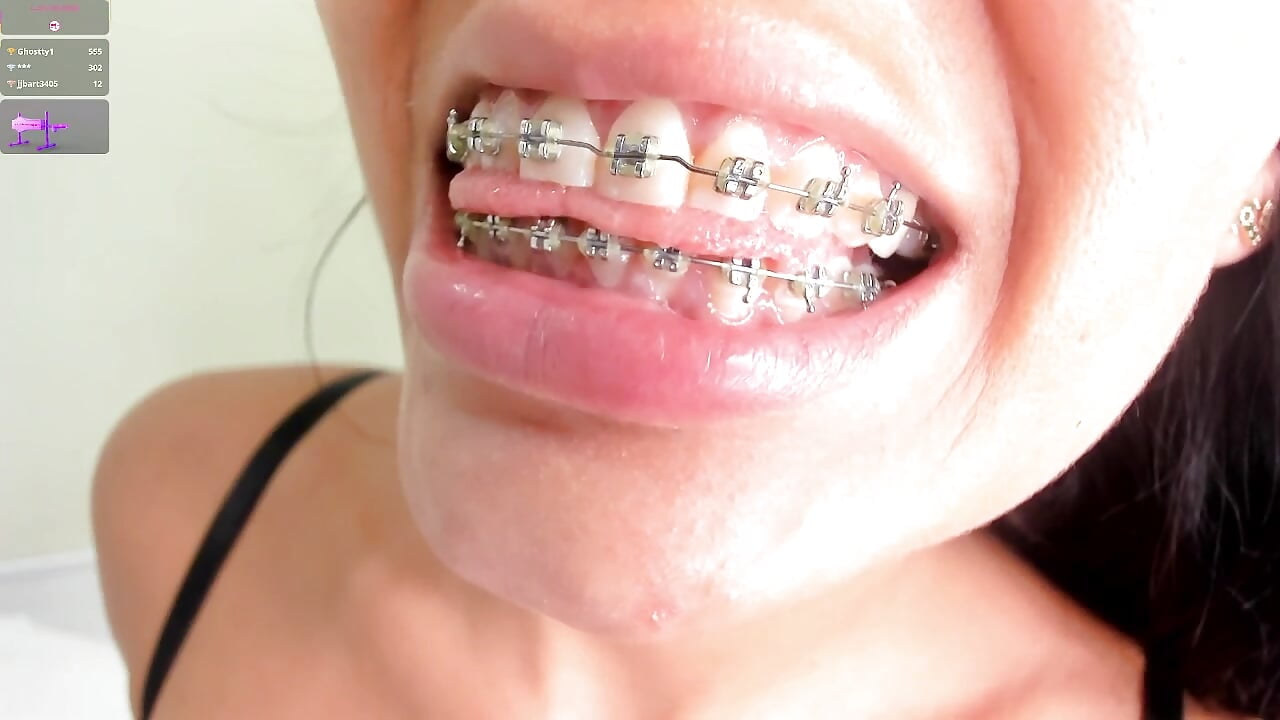 SHOW BRACES👄