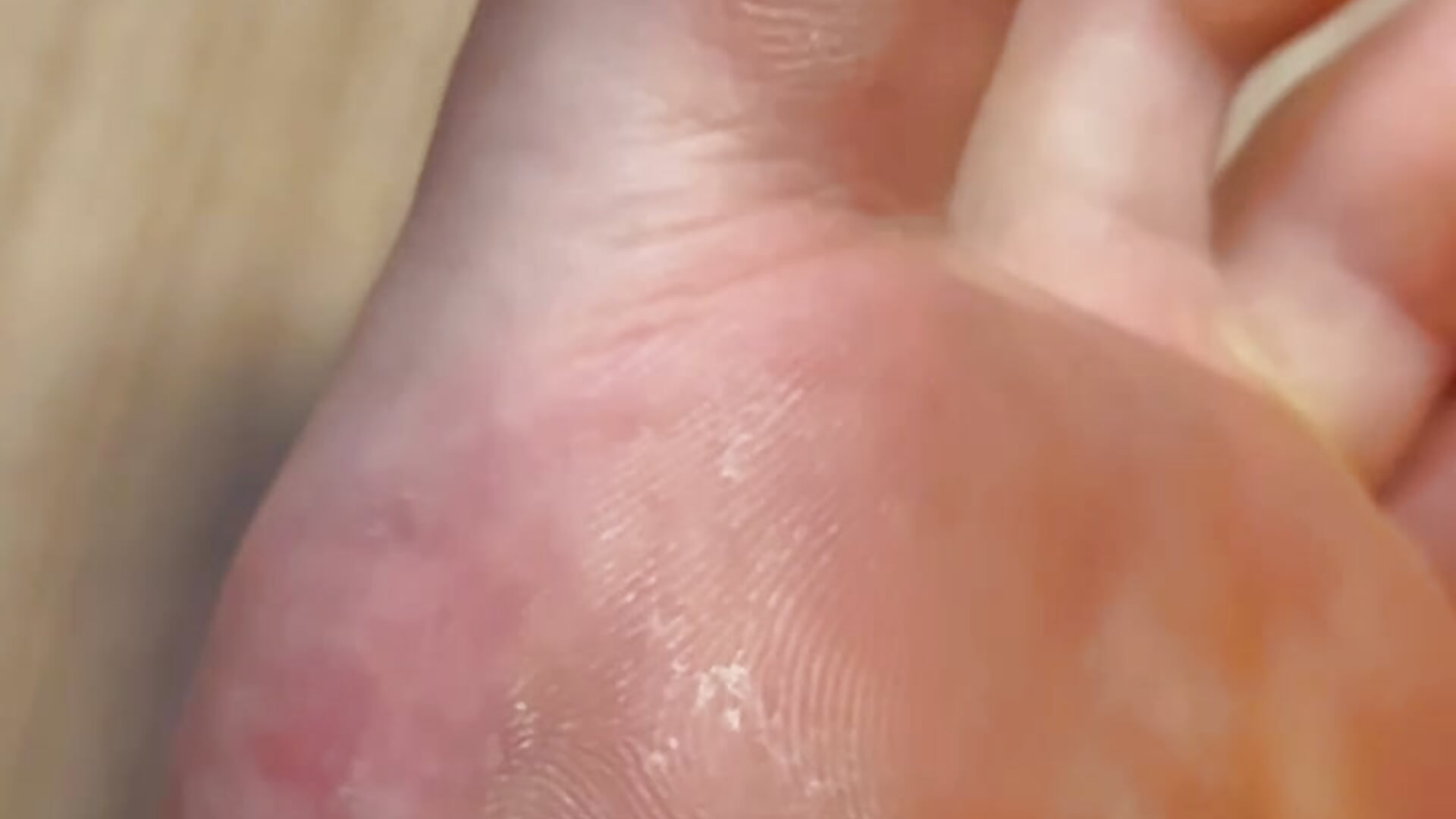 Dry soles and toes skin